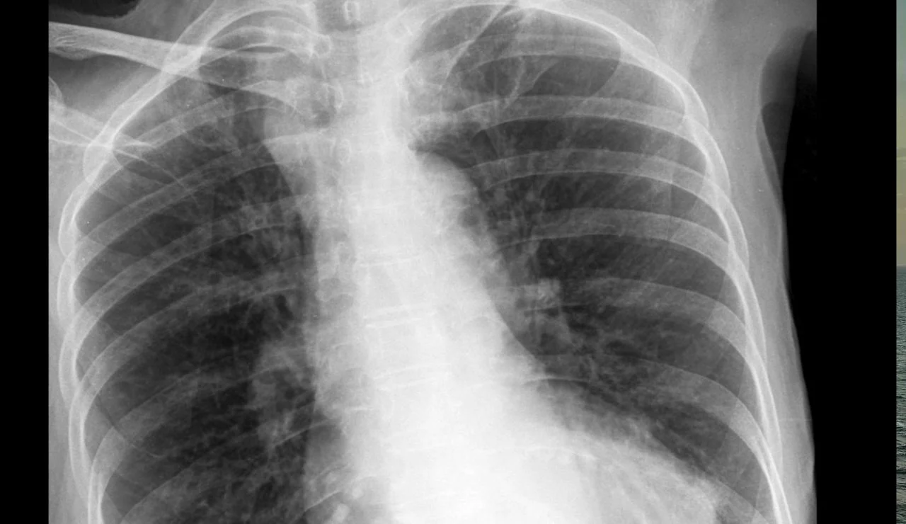 ilustrasi paru-paru terkena pneumonia akibat campak,